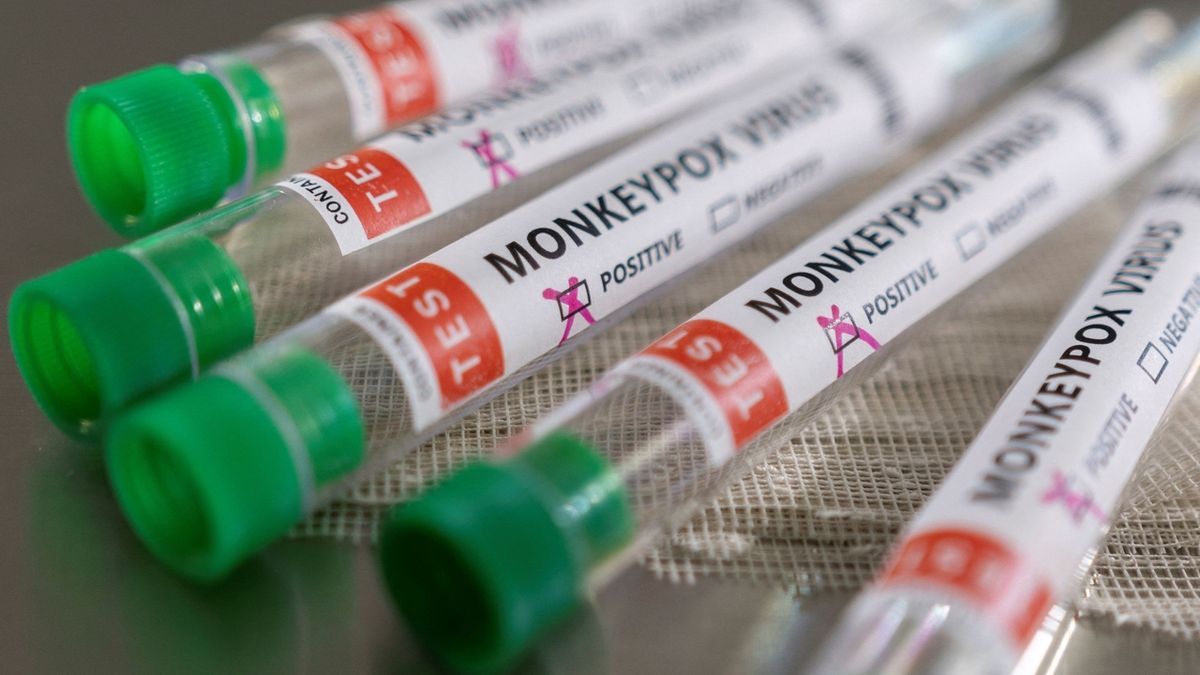 V Česku zemřel první pacient s opičími neštovicemi